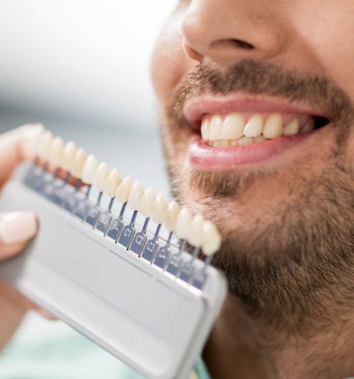 Man's smile compared with a veneer shade chart