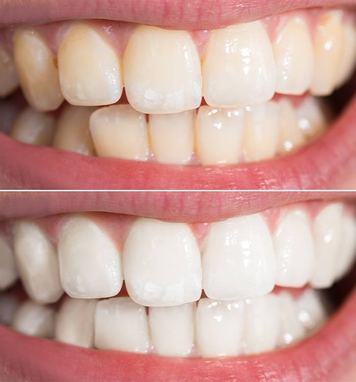 Smile before and after teeth whitening