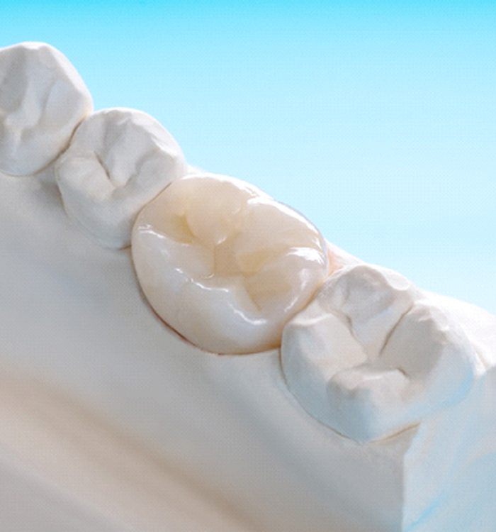 An up-close image of a dental crown sitting in a mouth mold