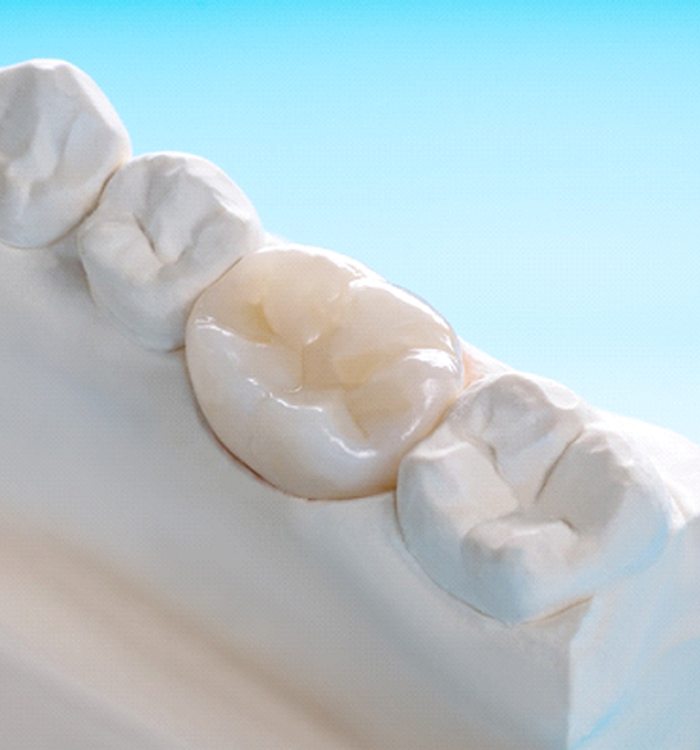 A close up of a dental crown sitting in a mouth mold