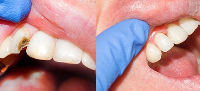 A before and after image of a person who received a dental crown to cover a broken and decayed tooth
