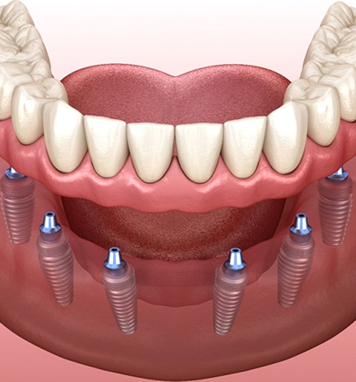 Digital illustration of implant dentures