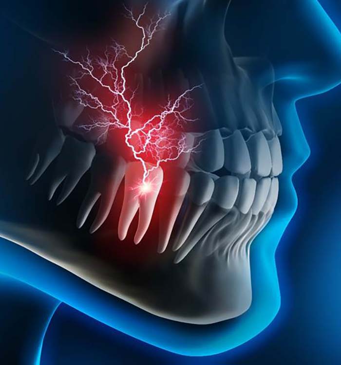 X-ray illustration of a toothache