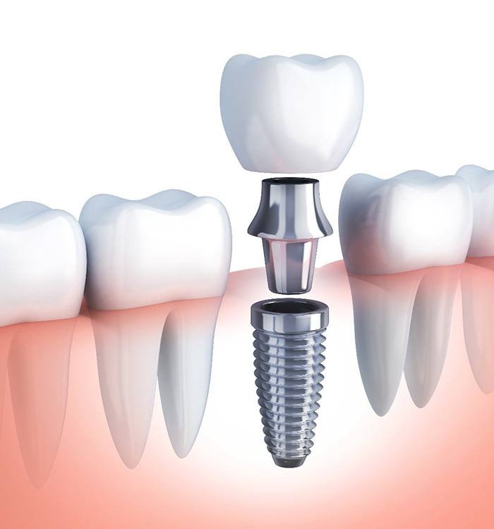 diagram of a dental implant in Trumbull