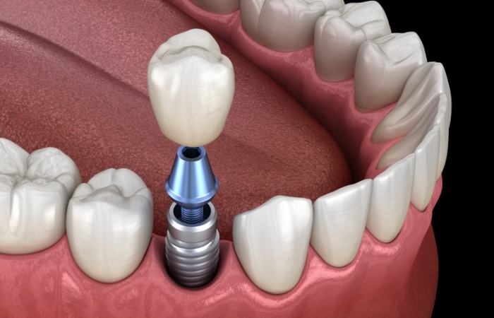 Animated dental crown placed on dental implant