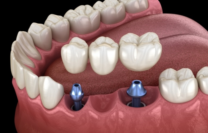 Animated dental bridge placed on two dental implants