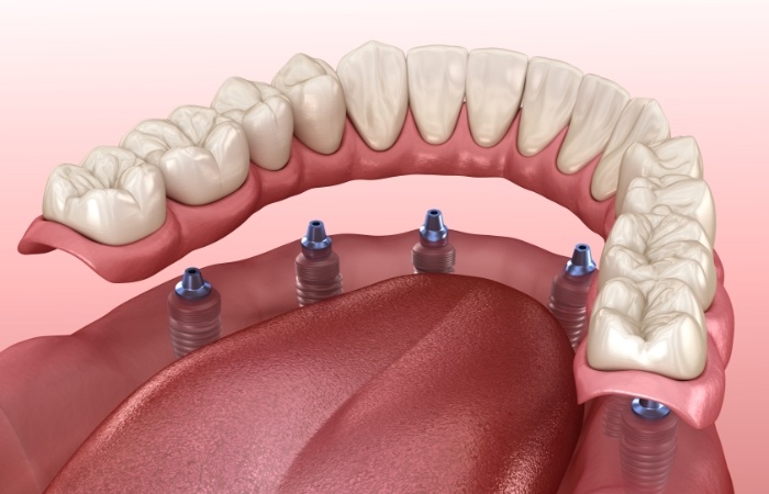 Animated denture placed on six dental implants