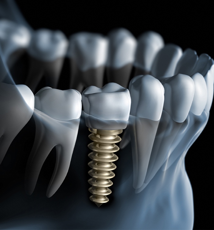 Animated smile with dental implant