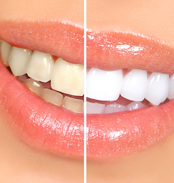Woman’s teeth before and after teeth whitening in Trumbull