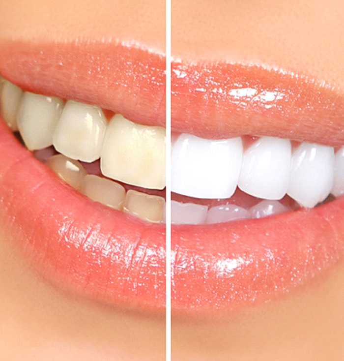 Woman’s teeth before and after teeth whitening