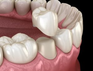 Porcelain dental crown in Trumbull being placed on tooth